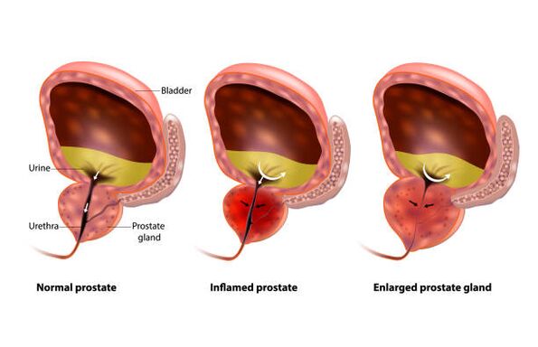 prostatitída je zápal prostaty