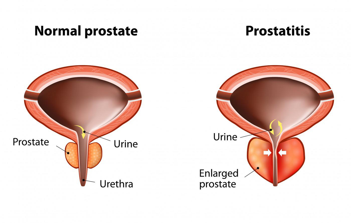 Normálna prostata zdravého muža a zápal prostaty s prostatitídou